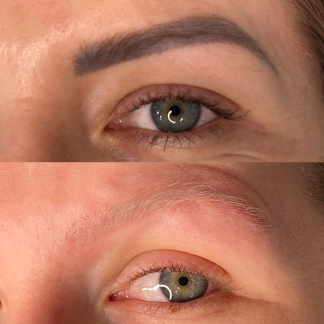 Remoção de Micropigmentação — Antes e Depois